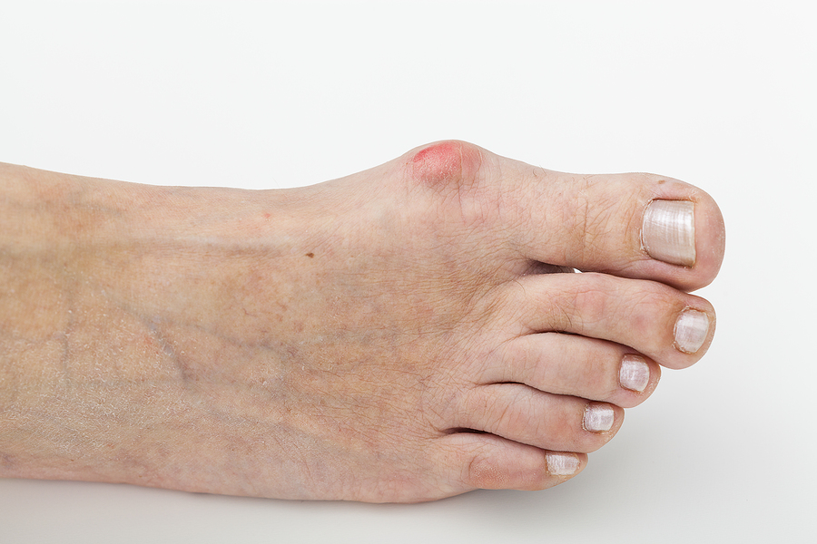 bigstock-Bunion-Isolated-Background-49248116