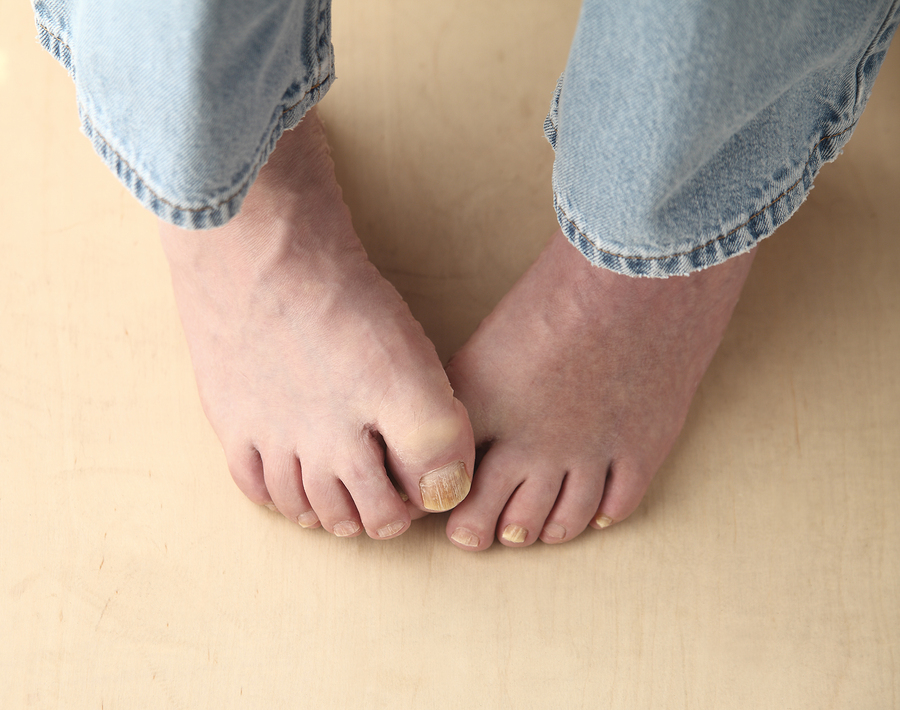 man tries to hide his toenail fungus